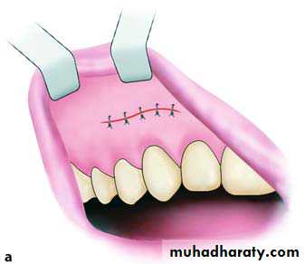 surgical aid to orthodonatic