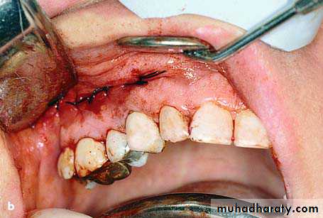 surgical aid to orthodonatic