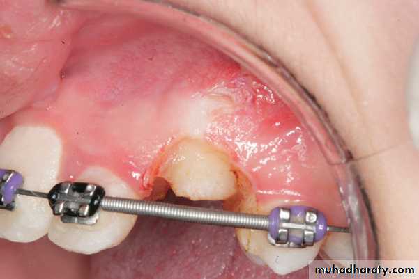 surgical aid to orthodonatic