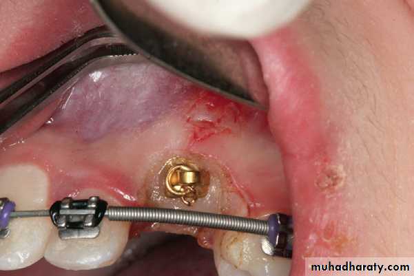 surgical aid to orthodonatic