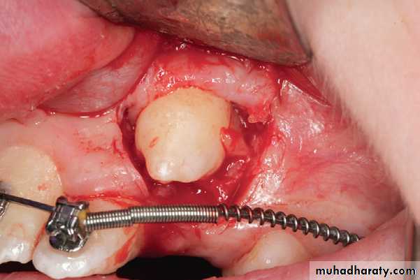 surgical aid to orthodonatic