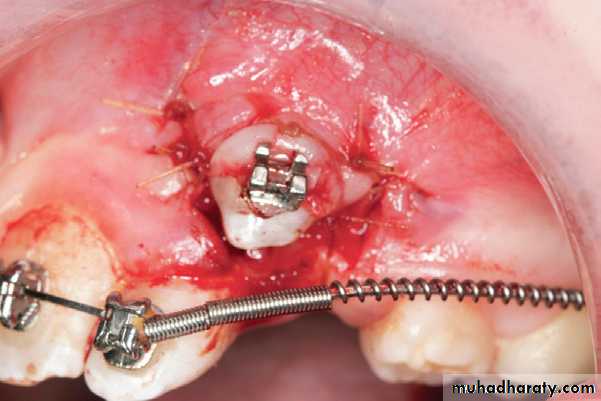 surgical aid to orthodonatic