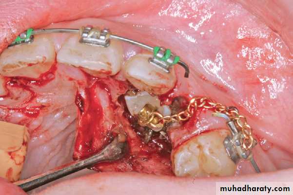 surgical aid to orthodonatic