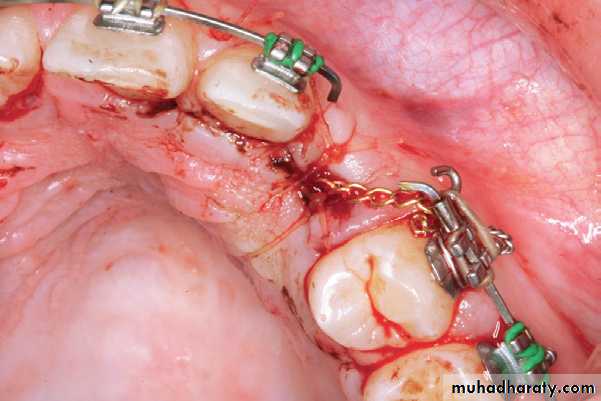 surgical aid to orthodonatic