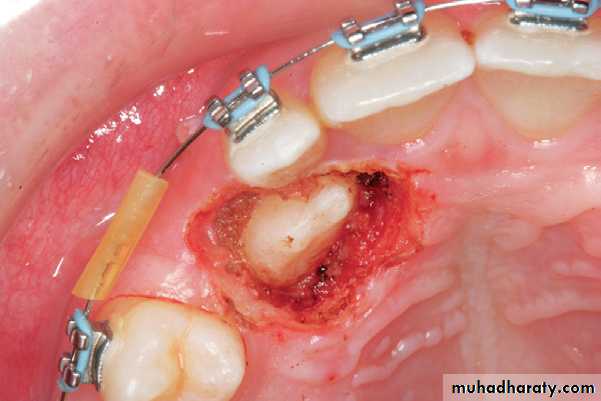 surgical aid to orthodonatic