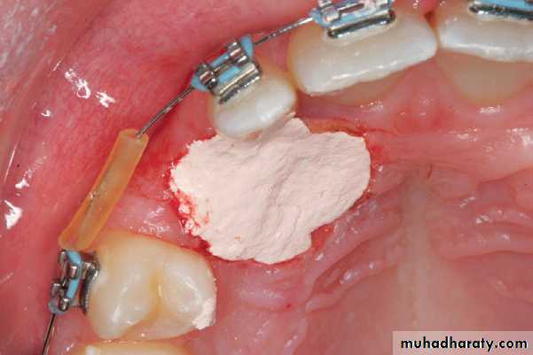 surgical aid to orthodonatic
