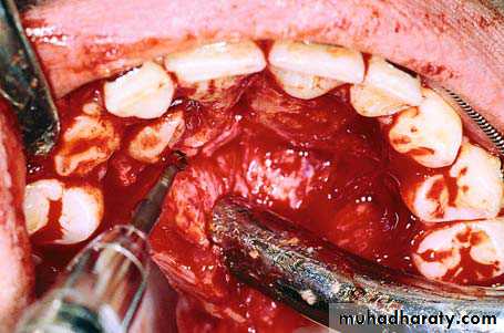 surgical aid to orthodonatic