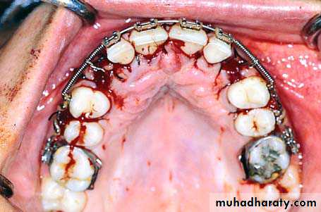 surgical aid to orthodonatic