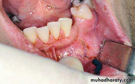 surgical aid to orthodonatic