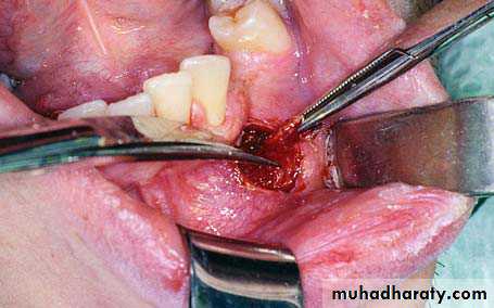 surgical aid to orthodonatic