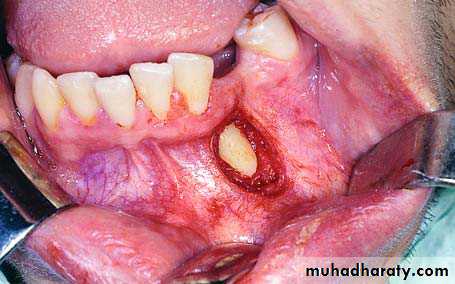 surgical aid to orthodonatic
