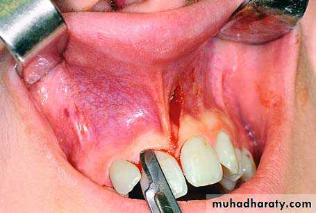 surgical aid to orthodonatic