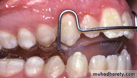 open bite