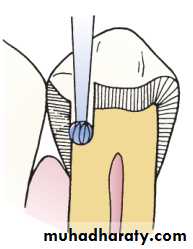 Tooth preparation