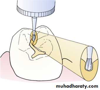 Tooth preparation