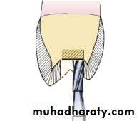 Tooth preparation