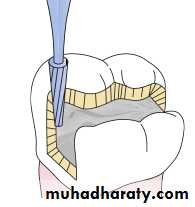 Tooth preparation