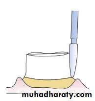 Tooth preparation