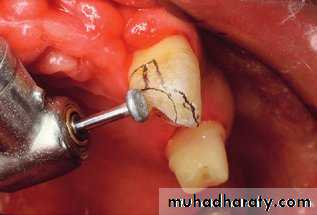 Tooth preparation