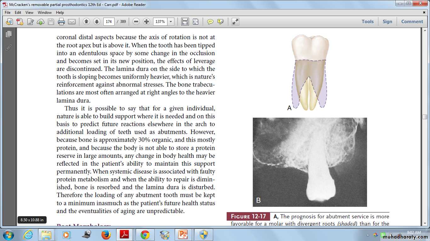 Partial denture