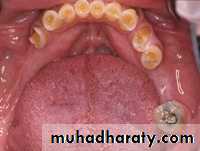 Partial denture