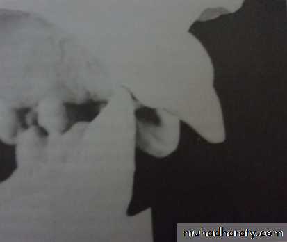 Partial denture