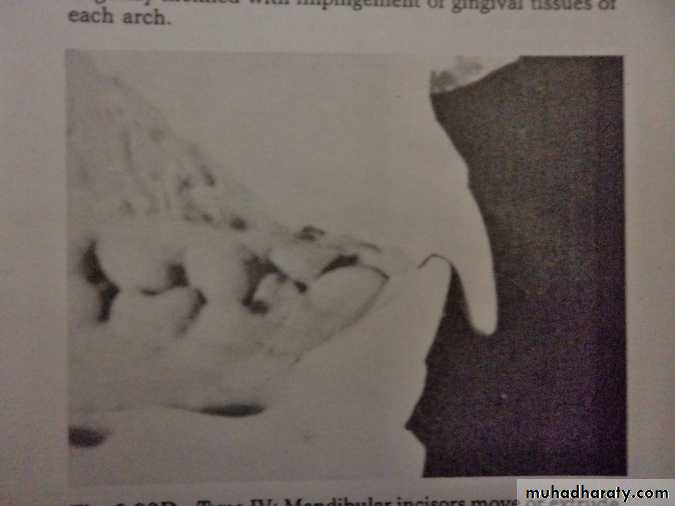 Partial denture