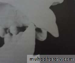 Partial denture