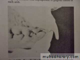 Partial denture