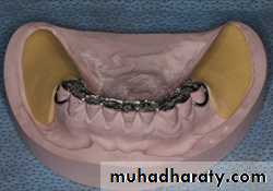 Partial denture