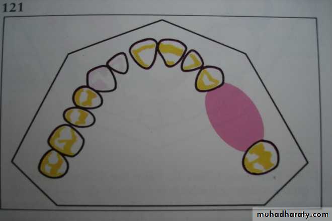 Partial denture