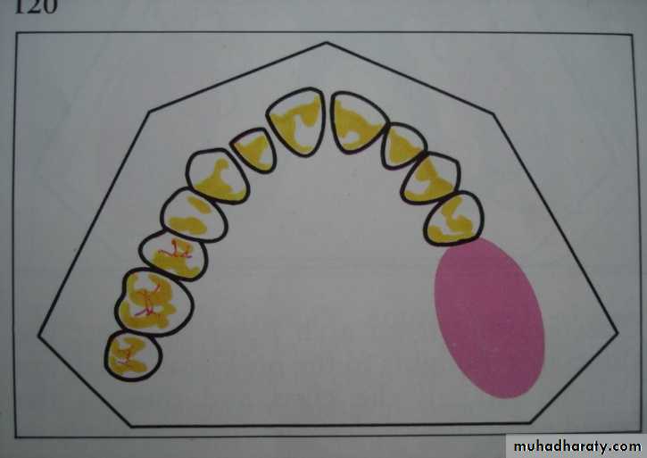 Partial denture