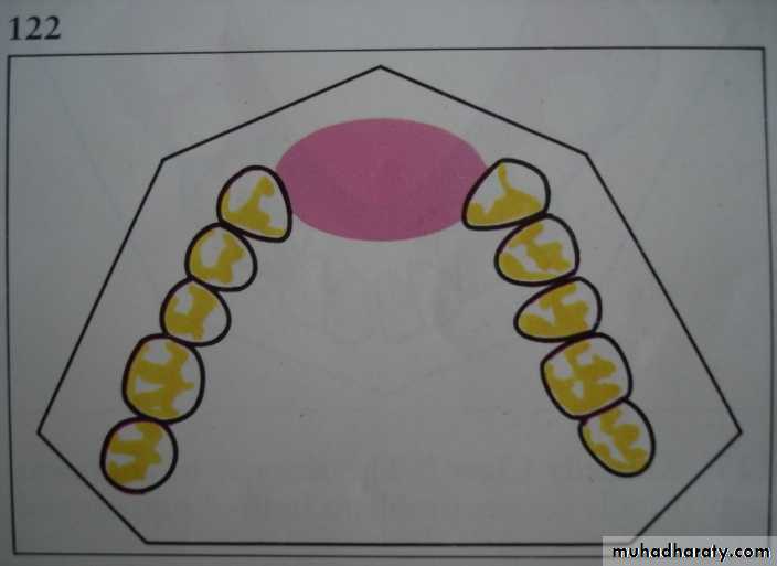 Partial denture