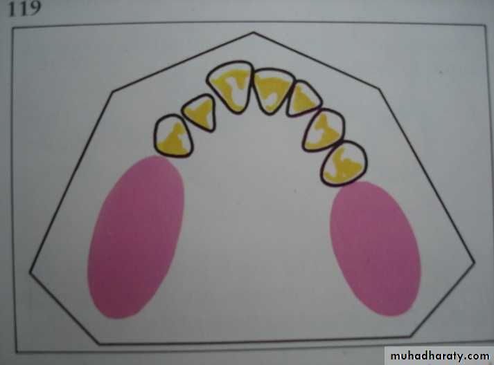 Partial denture