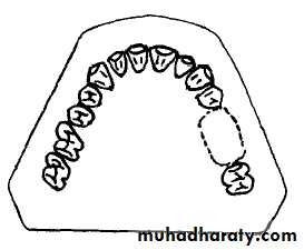 Partial denture
