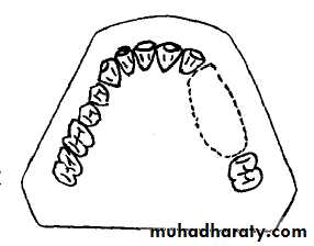 Partial denture