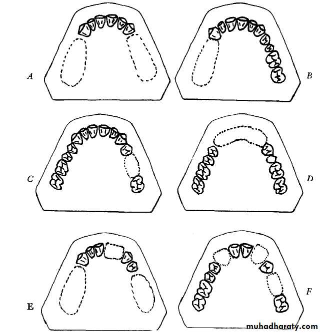 Partial denture