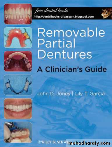 Partial denture
