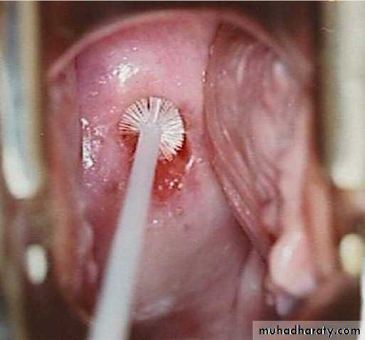 Premalignat disease