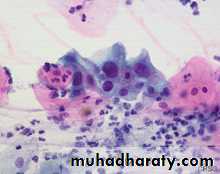 Premalignat disease