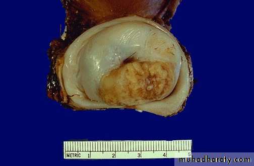Premalignat disease