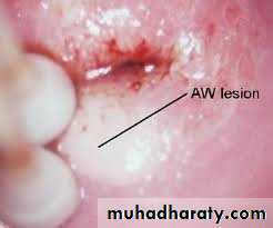 Premalignat disease