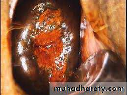 Premalignat disease