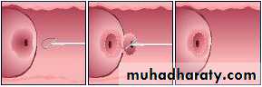 Premalignat disease