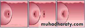 Premalignat disease