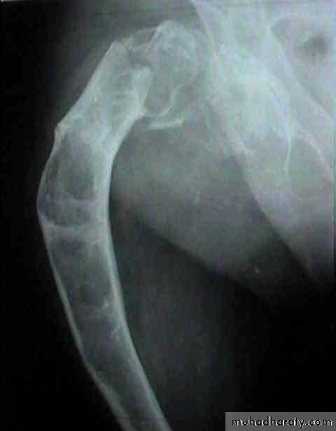 bone tumor2