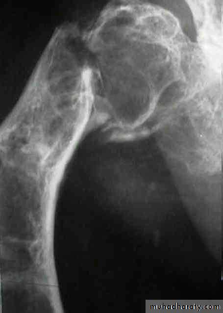bone tumor2