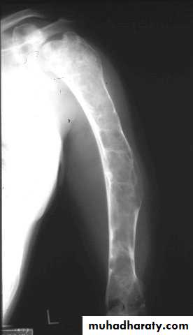 bone tumor2