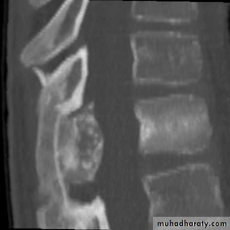 bone tumor2