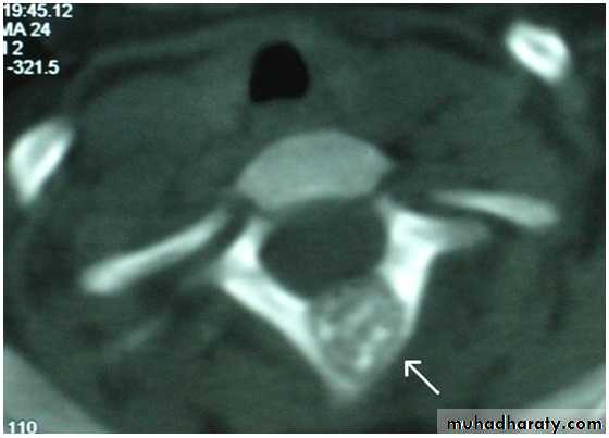 bone tumor2